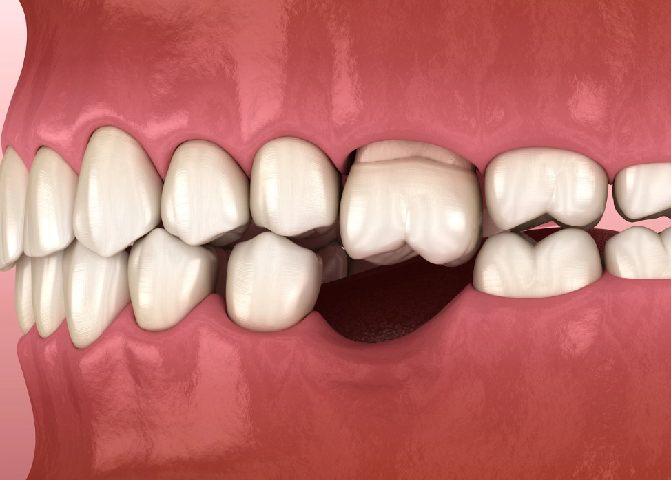 夢到掉牙齒 心理