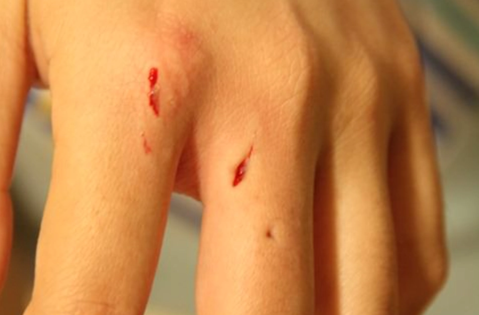 夢見狗咬手 夢見狗咬手