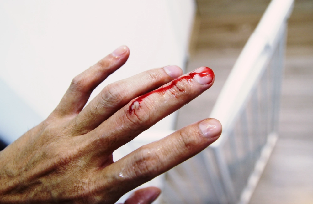 夢見狗咬手 夢見狗咬手