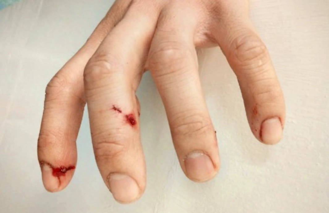 夢見狗咬手 夢見狗咬手