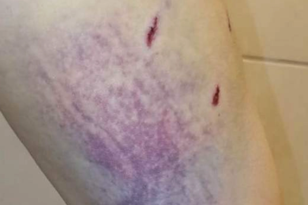 狗咬夢境心理學