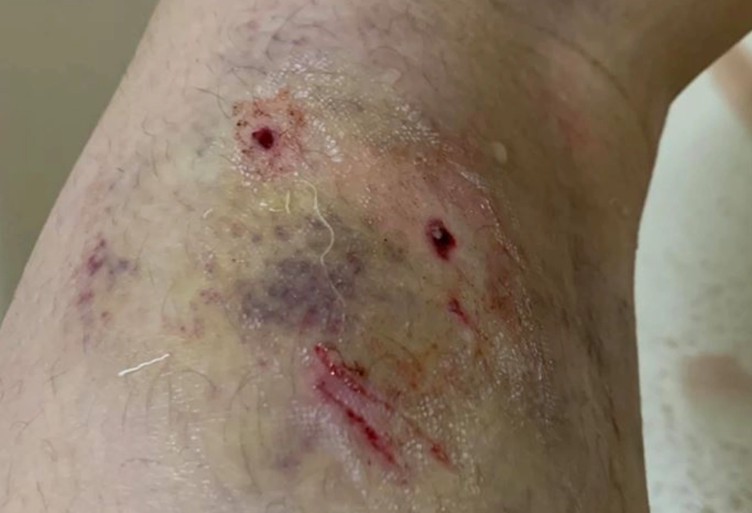 狗咬夢境心理學