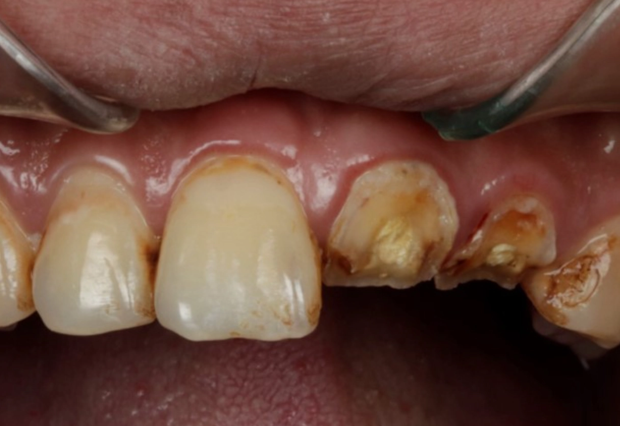 牙齒掉落夢境解析 牙齒掉落夢境解析