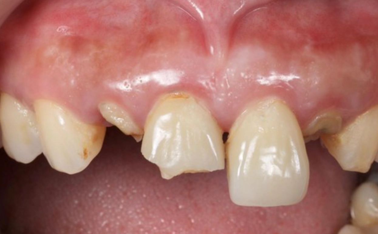 夢到牙齒碎掉吐出來？心理學專家解析夢境意義與實用應對指南