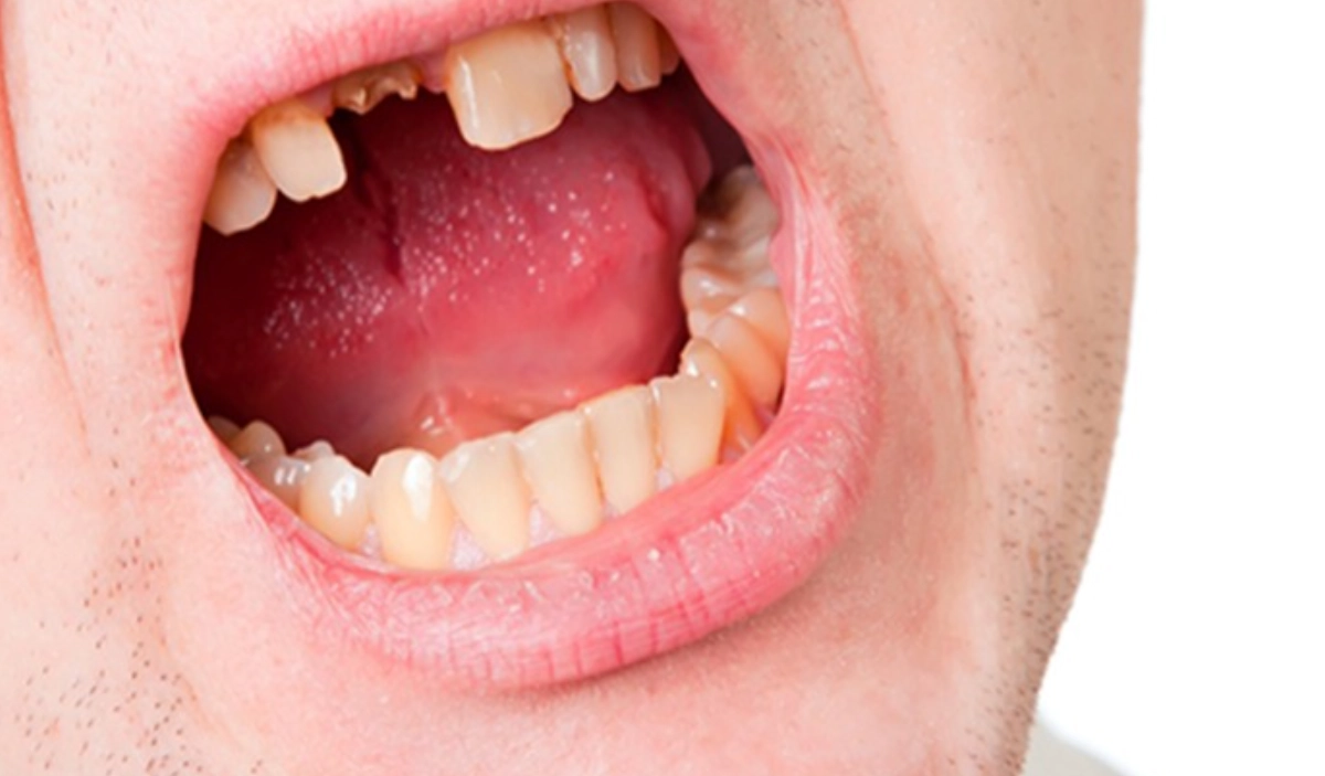 夢到牙齒掉一顆上牙：解夢、心理分析與實用指南