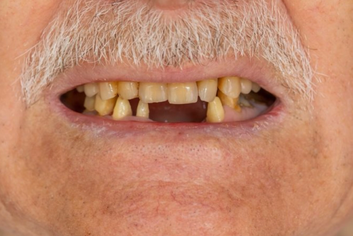 夢見牙齒掉兩顆：解析夢境意義與心理影響的完整指南