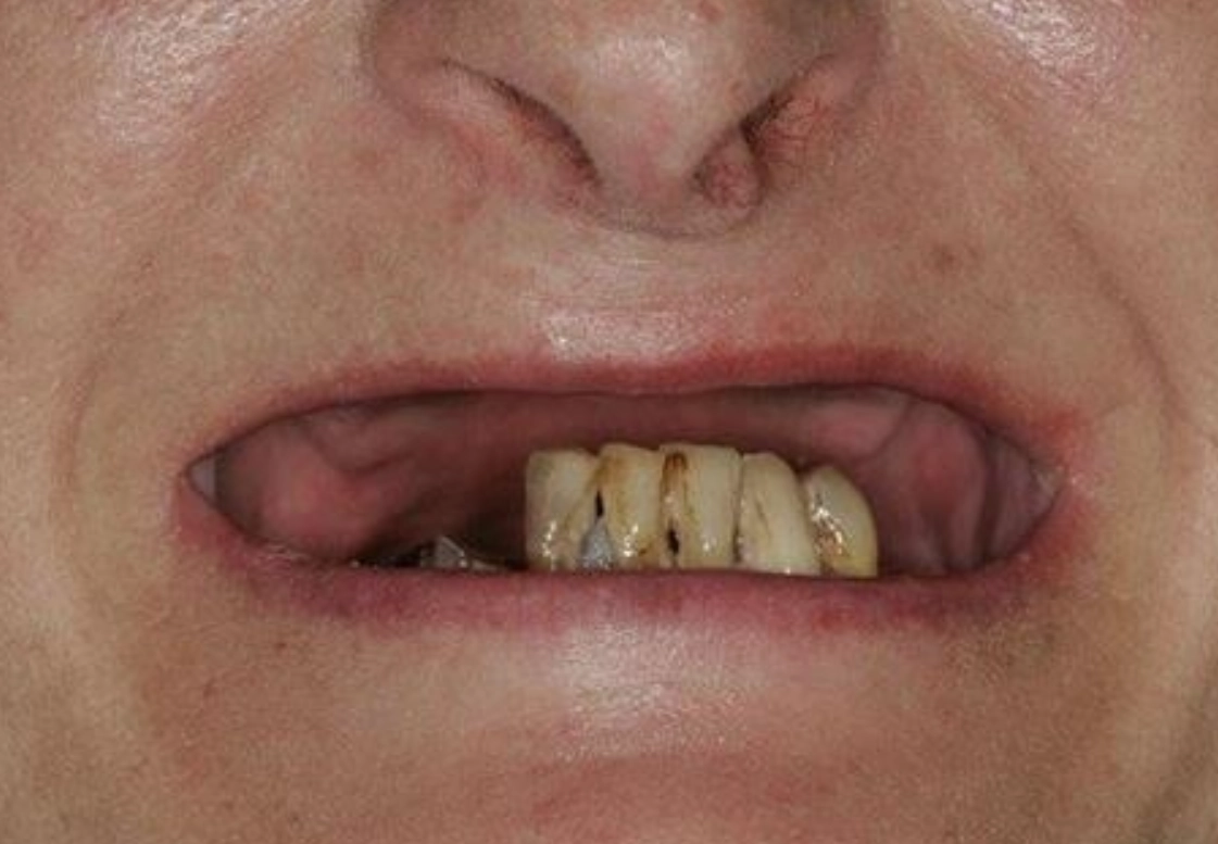 夢到牙齒掉落意思