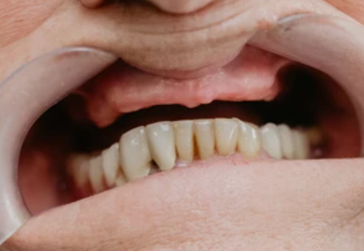 夢到牙齒掉一排代表什麼？從心理學與健康角度深度解析