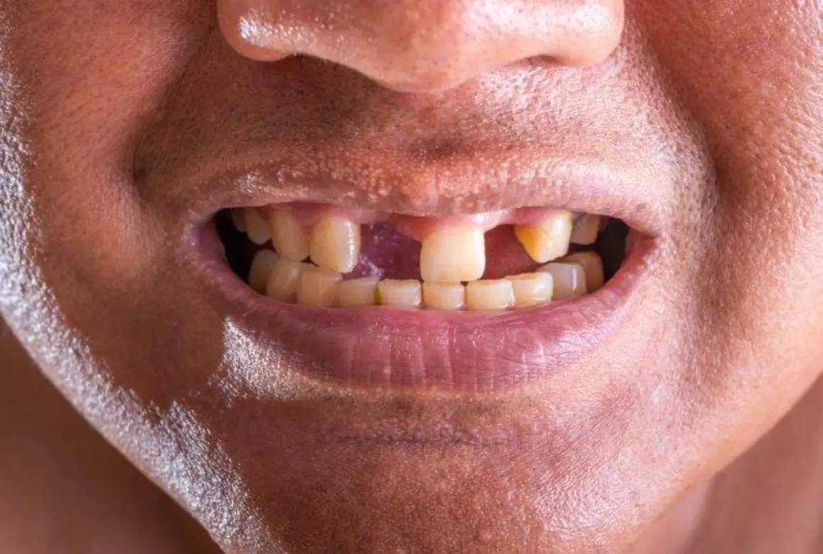 牙齒掉落夢境解析 牙齒掉落夢境解析