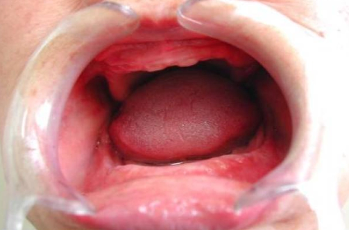 掉牙齒夢境 解析