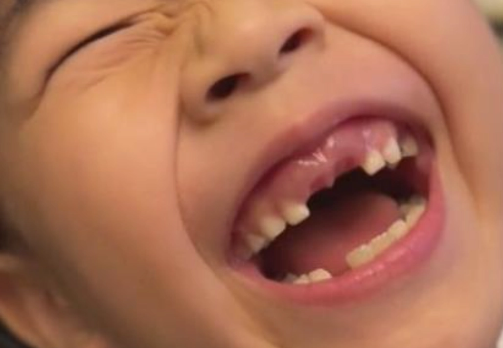 掉2顆牙齒夢境 掉2顆牙齒夢境