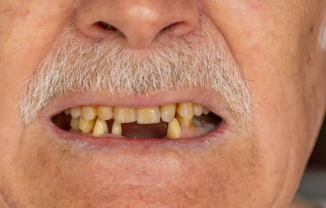 夢見掉牙齒解夢 夢見掉牙齒解夢