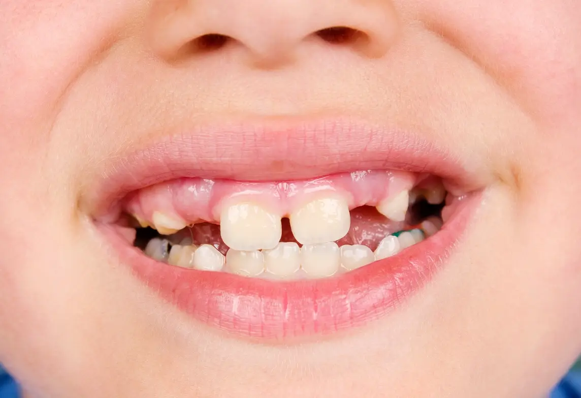 掉2顆牙齒夢境 掉2顆牙齒夢境