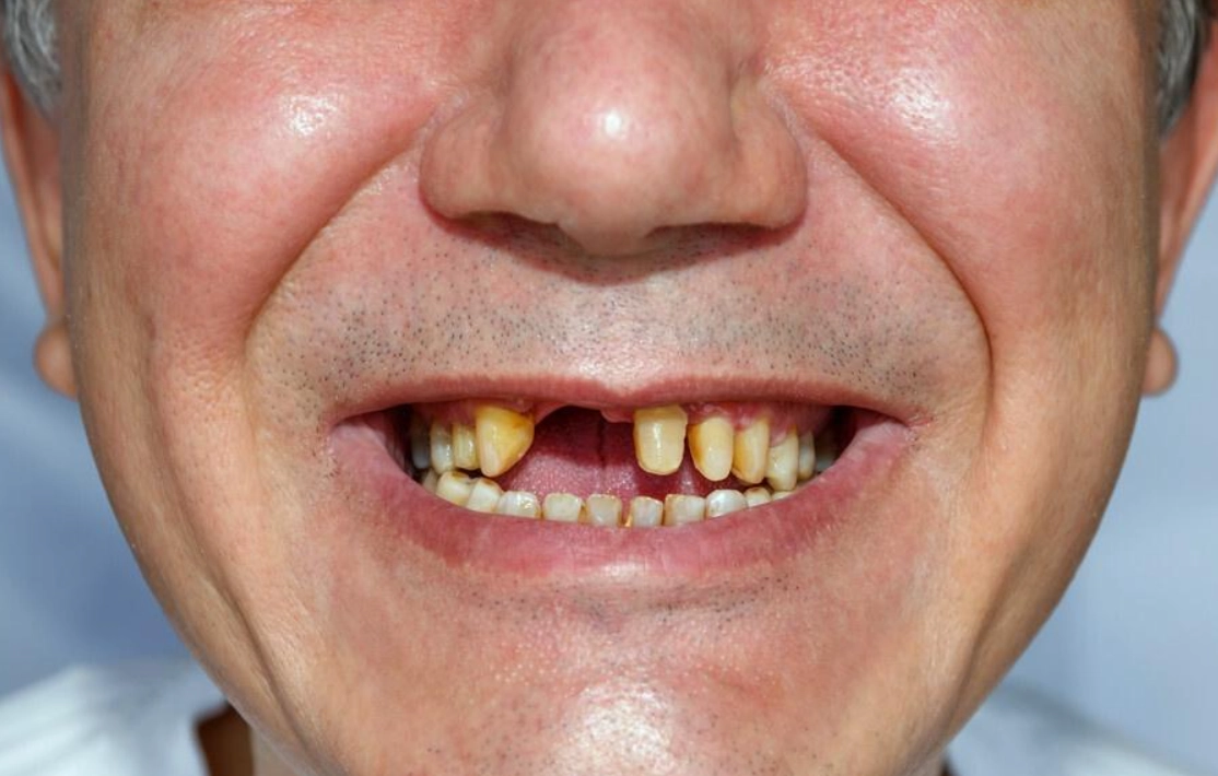 周公解夢掉牙齒 周公解夢掉牙齒