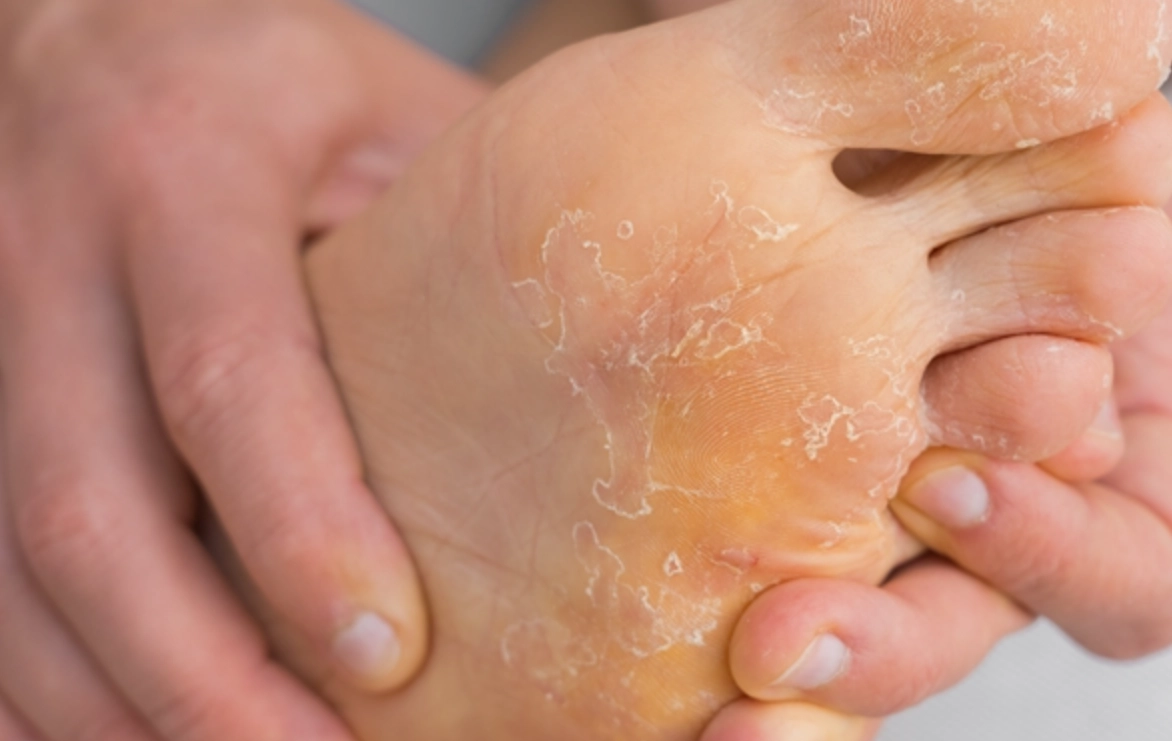 香港腳治療方法