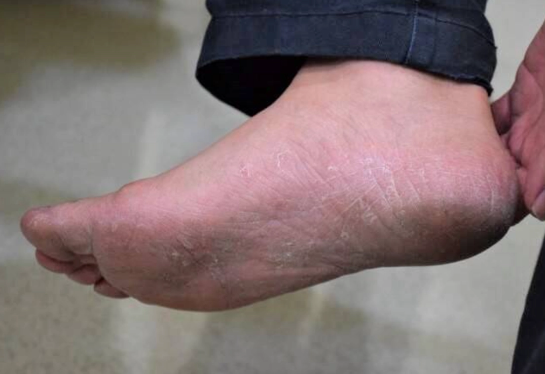 漂白水香港腳比例