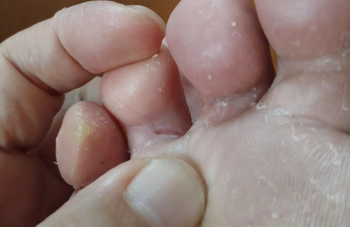 漂白水香港腳真的有效？皮膚科醫師警告：用錯比例恐灼傷