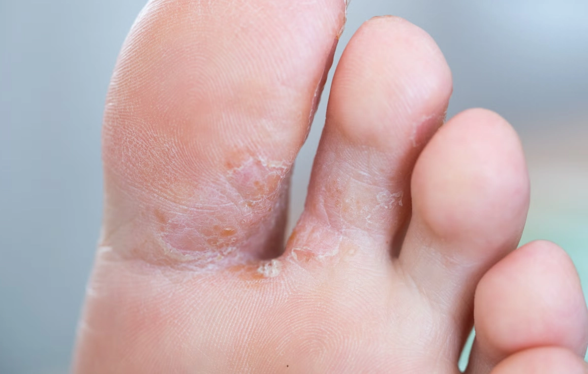 漂白水香港腳有效嗎