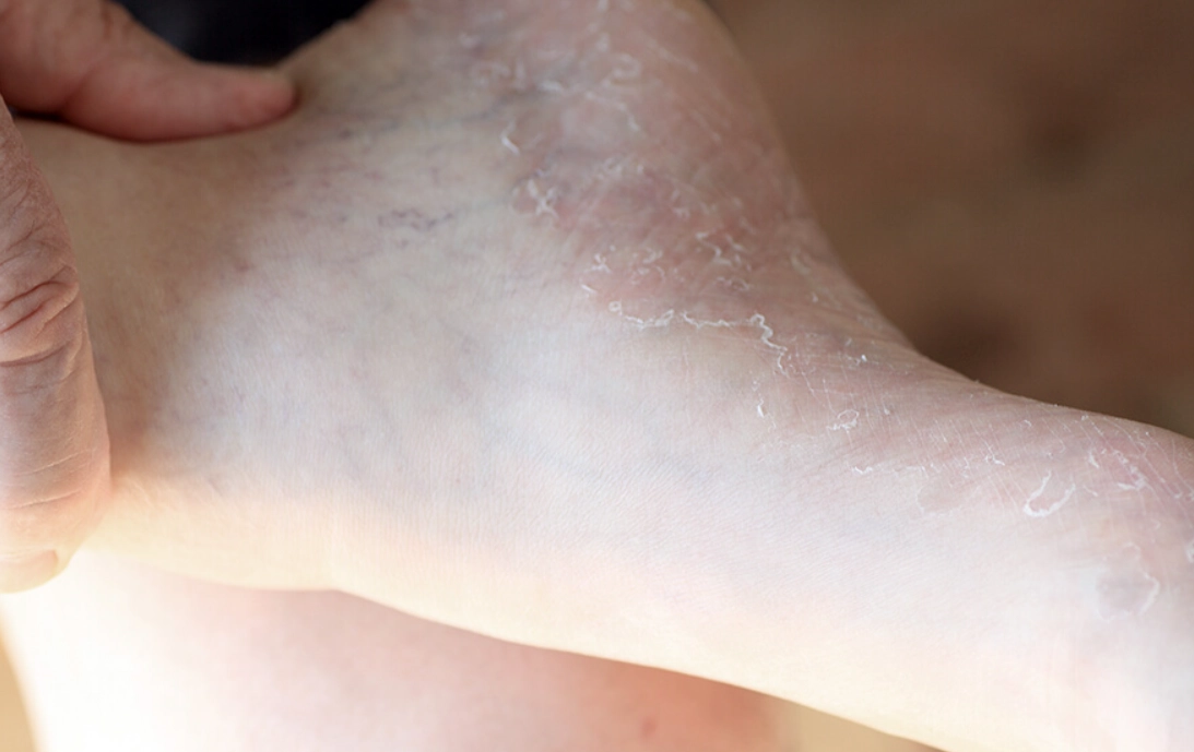 香港腳治療方法