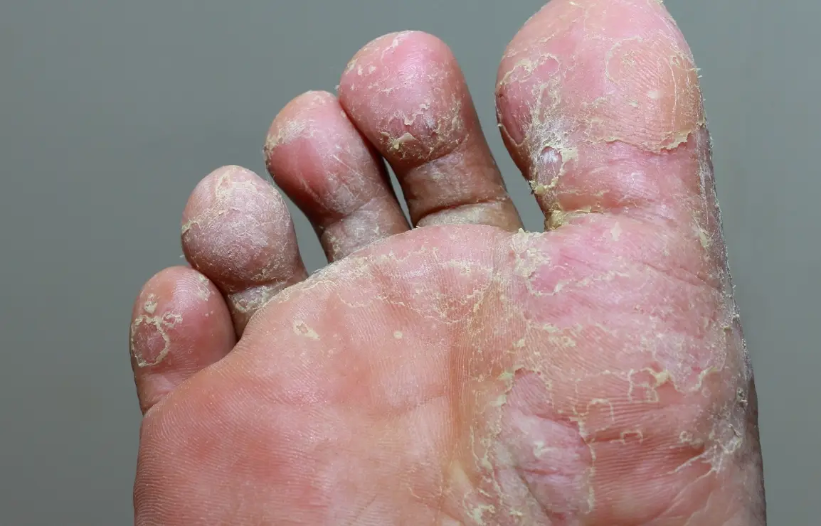 漂白水香港腳有效嗎