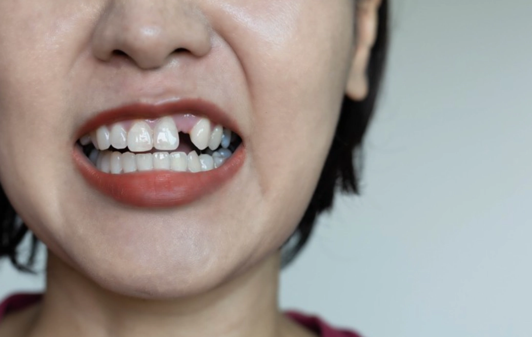 夢見掉牙齒解夢