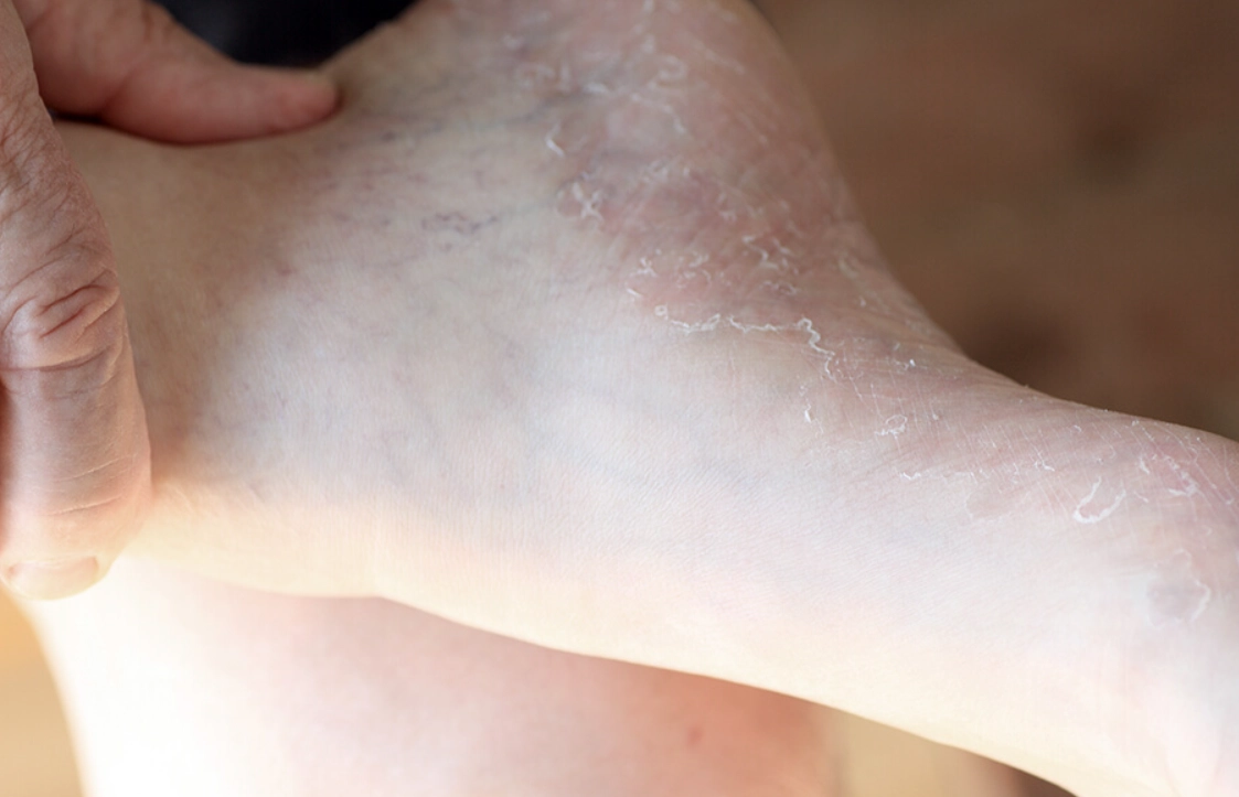 鞋子發霉香港腳關聯