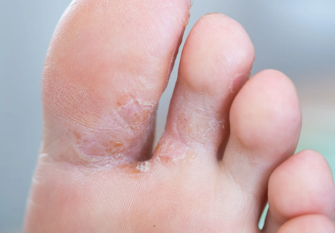 鞋子發霉與香港腳的終極解法：從預防到根治的完整指南