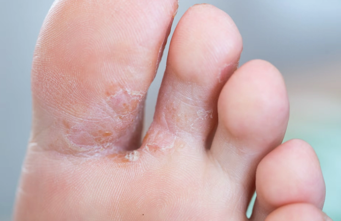 香港腳黴菌最怕什麼？破解黴菌三大弱點，告別腳癢困擾