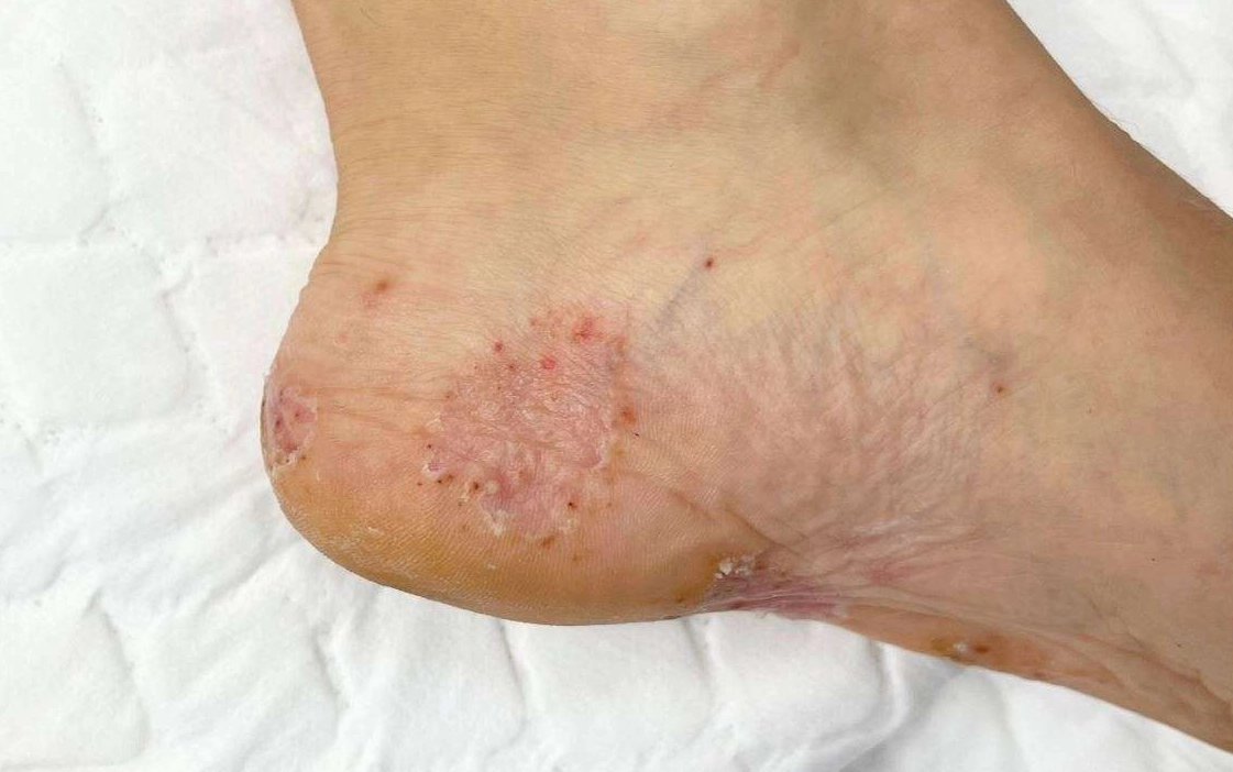 香港腳藥膏推薦