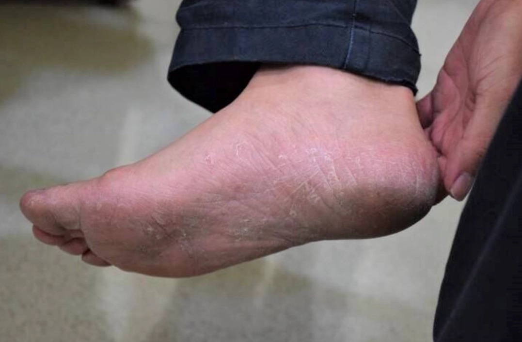 香港腳治療方法