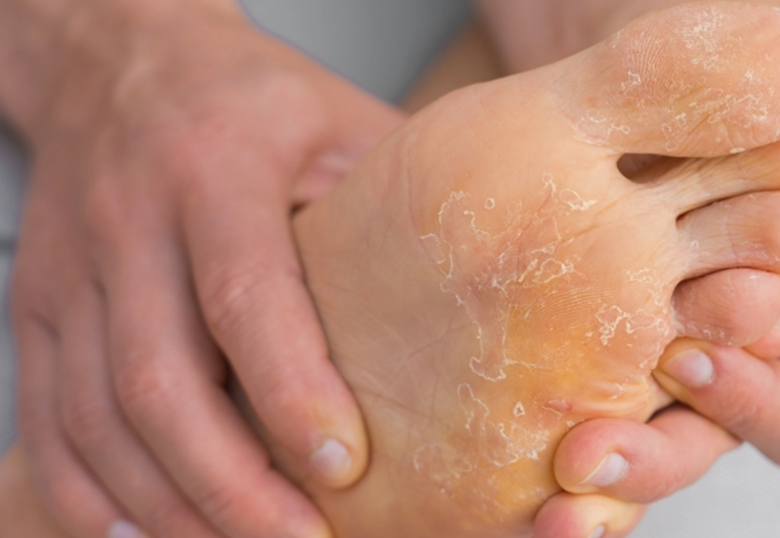 香港腳治療方法