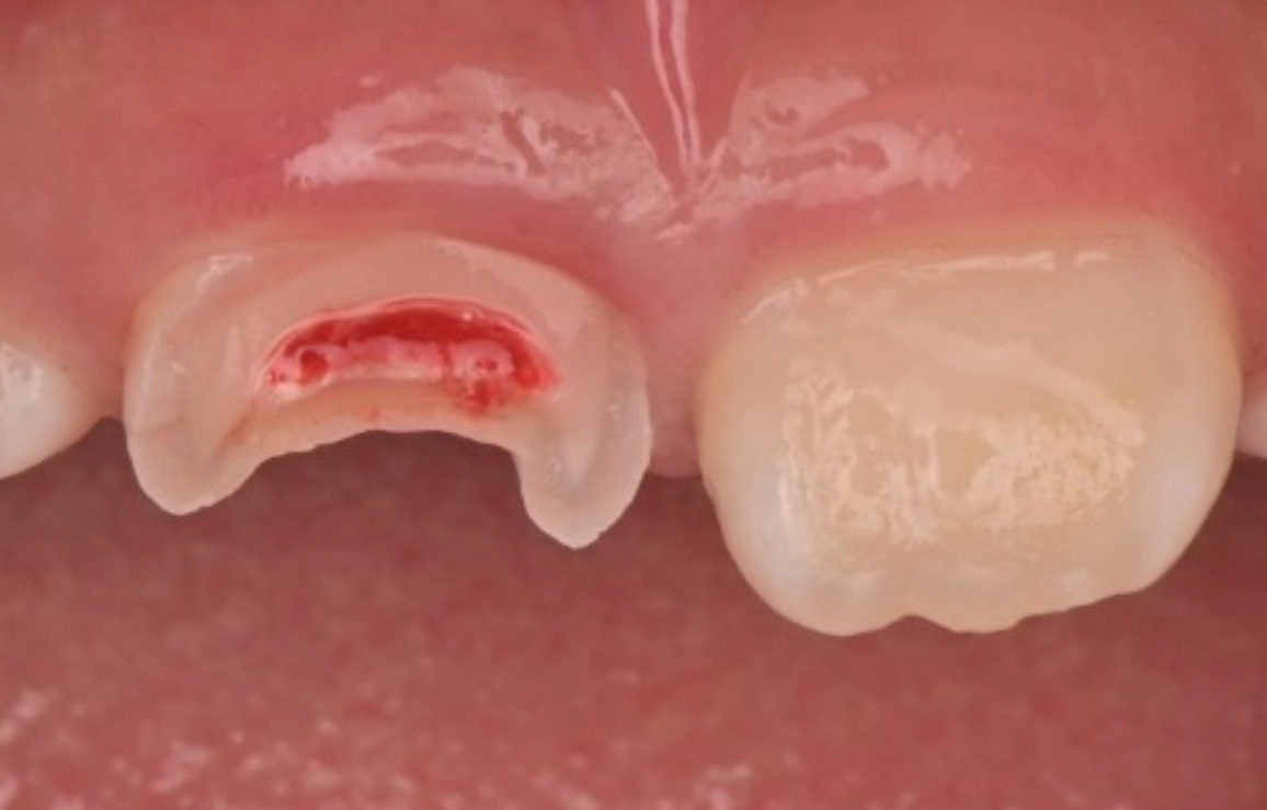 夢見牙齒斷一半是什麼意思？從解夢到心理學的深度解析與應對