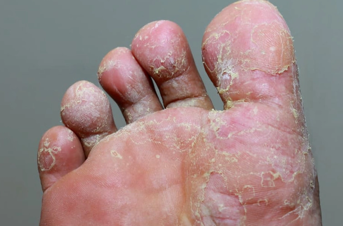 香港腳藥膏推薦