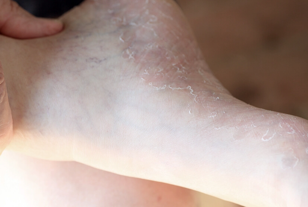 酒精消毒香港腳