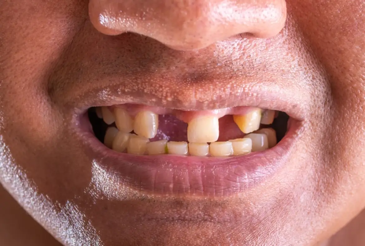 夢見牙齒掉了好幾顆？解夢師與心理師教你破解深層焦慮