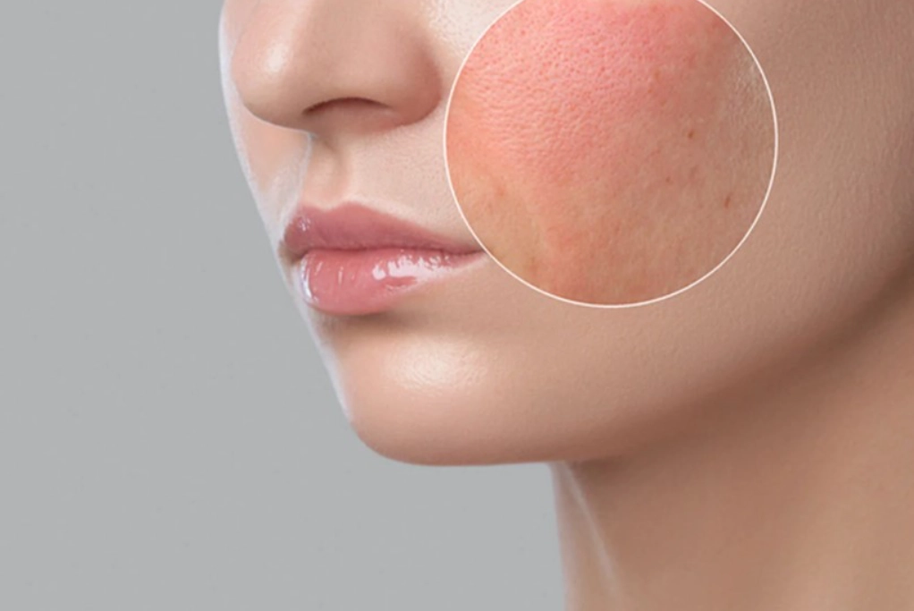 紅酵母清除全攻略：告別皮膚粗糙與暗沉的終極指南