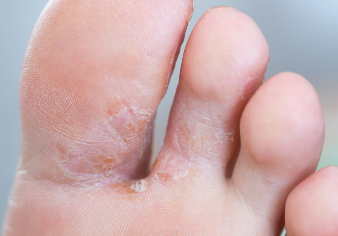 酒精消毒香港腳