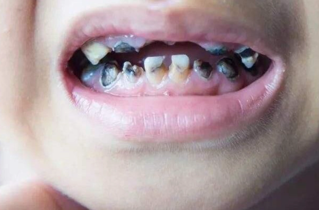 夢到牙齒掉落解夢