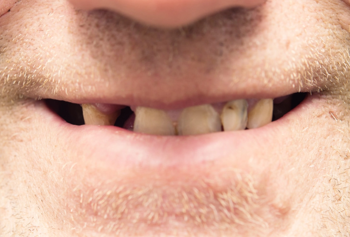 夢到牙齒掉很多？解夢師不說的5種真實含義與應對方法