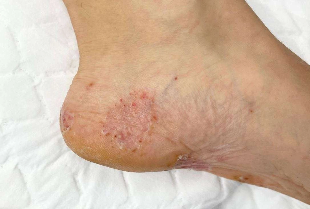 酒精消毒香港腳