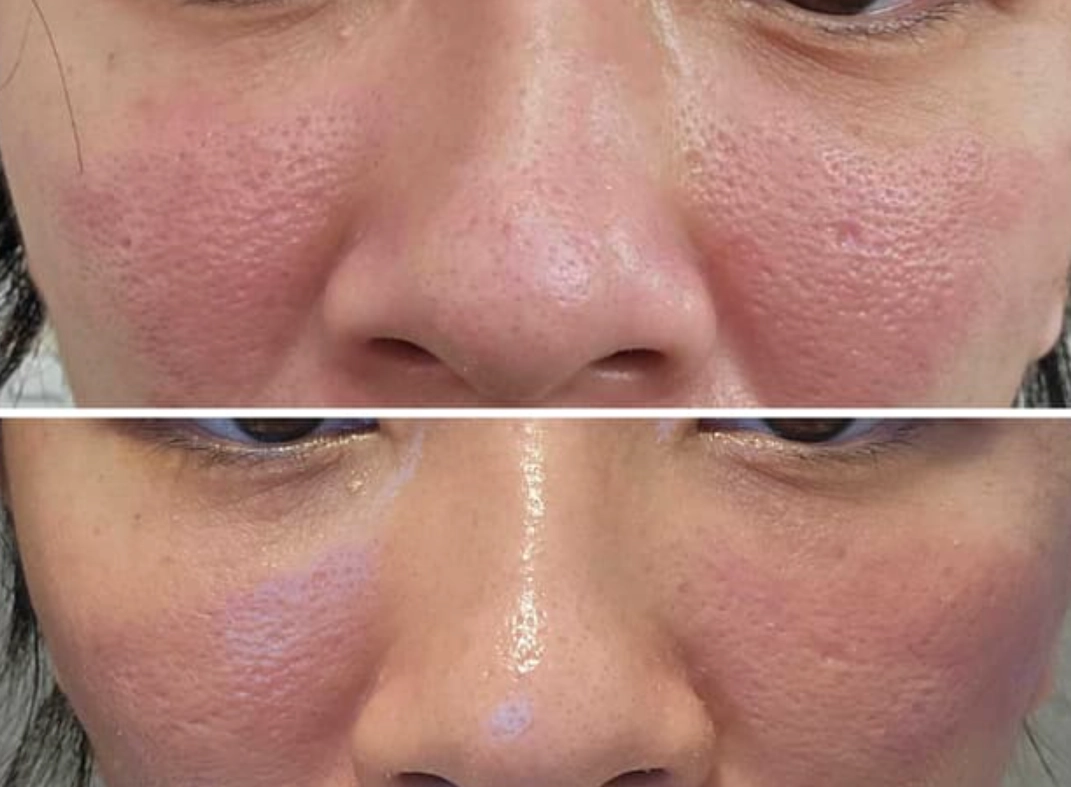 紅酵母皮膚問題