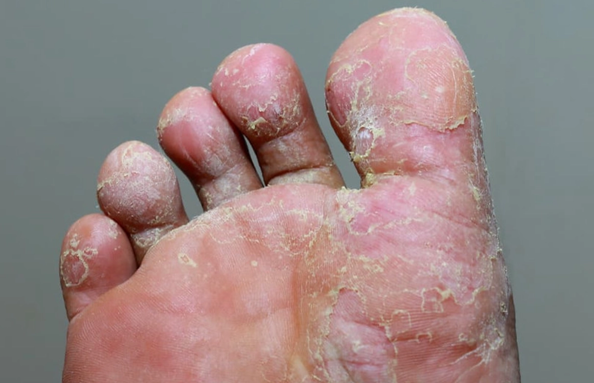 75酒精香港腳有效嗎？完整治療指南與常見誤區