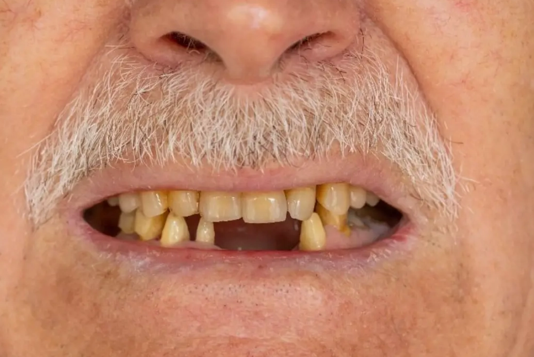 夢見牙齒掉落沒流血