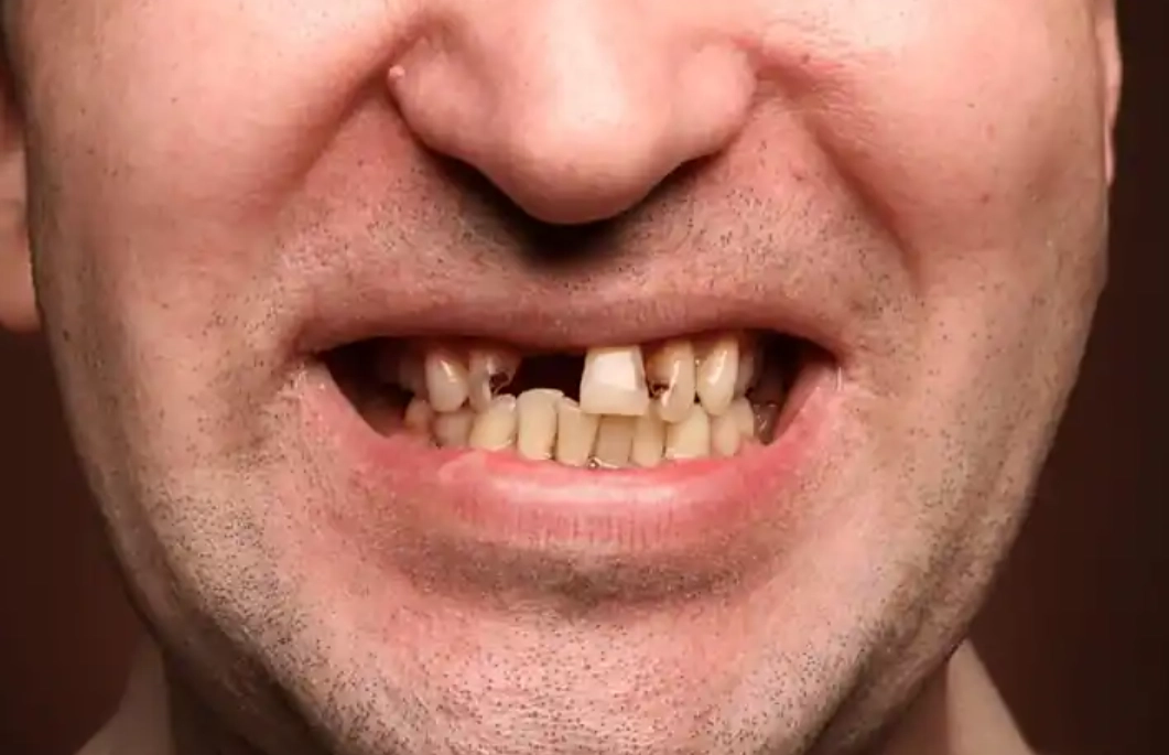 夢到牙齒掉落解夢