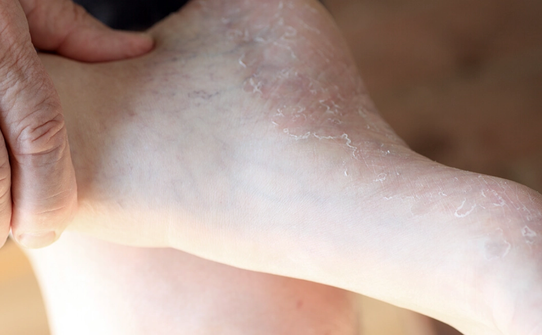 香港腳黴菌溫度