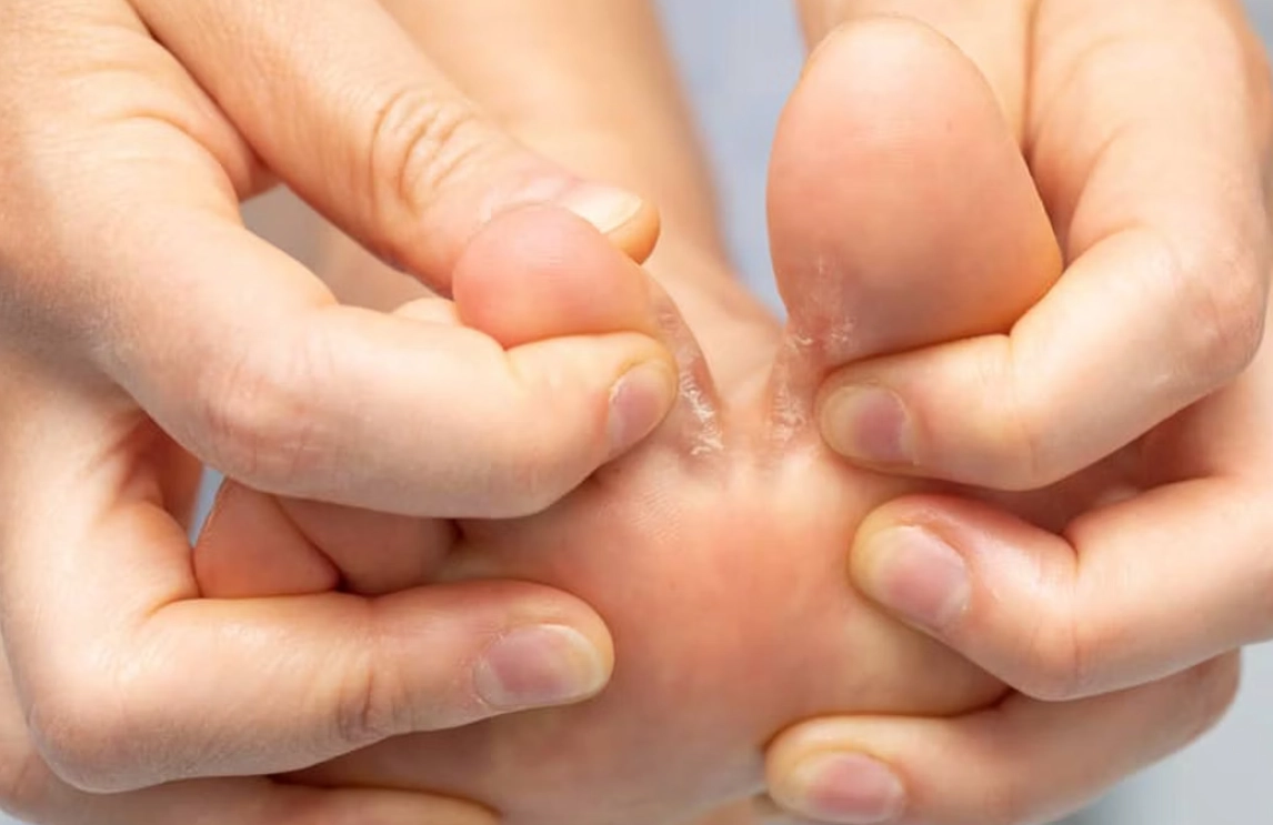 香港腳根治方法