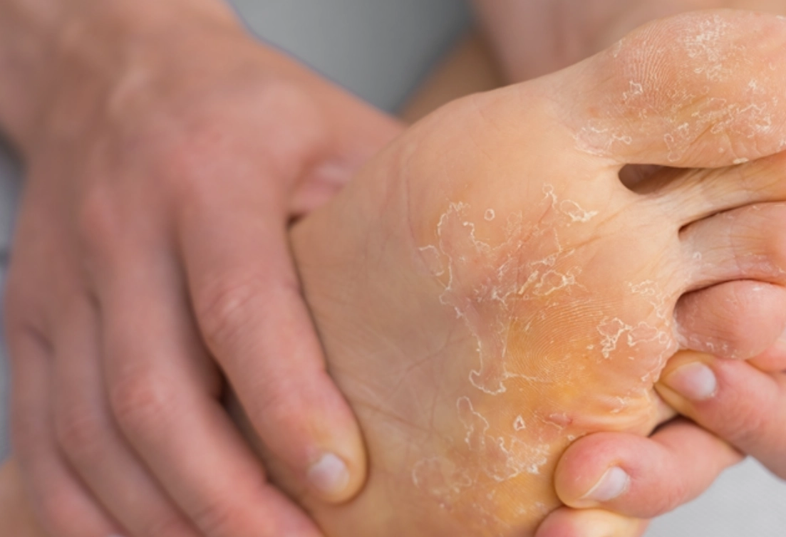 香港腳黴菌溫度