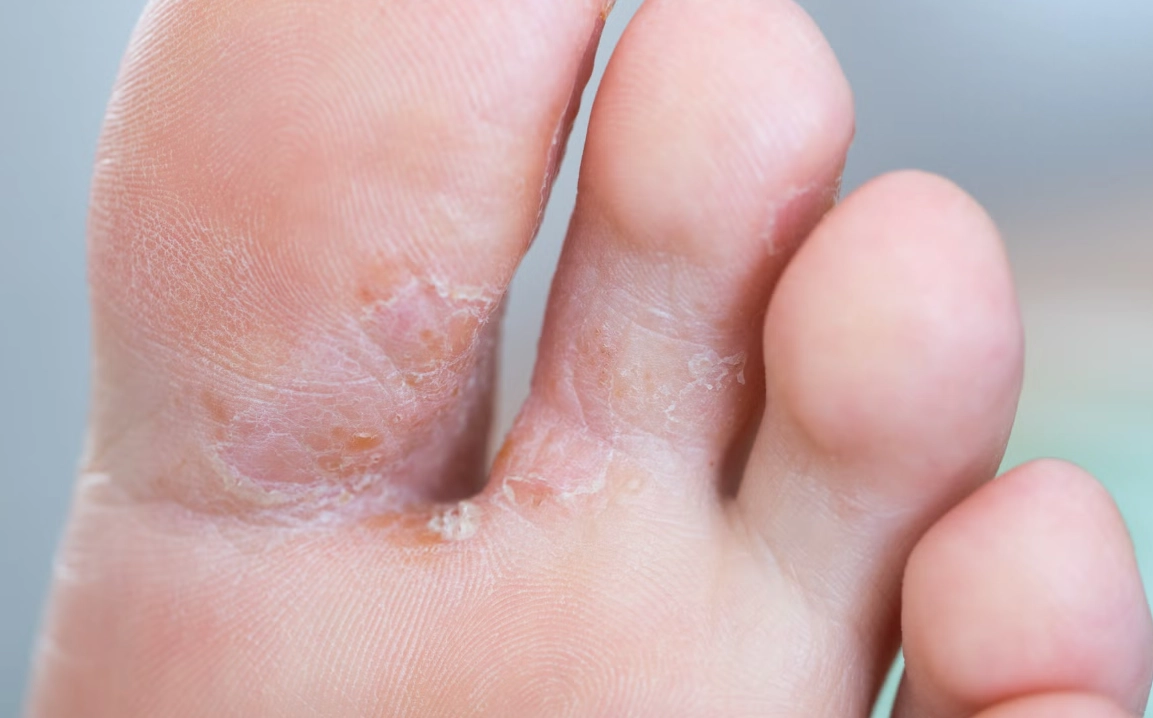 香港腳根治方法