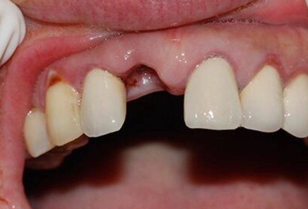 夢見牙齒掉一顆代表什麼？深度解析夢境焦慮與自我對話訊號