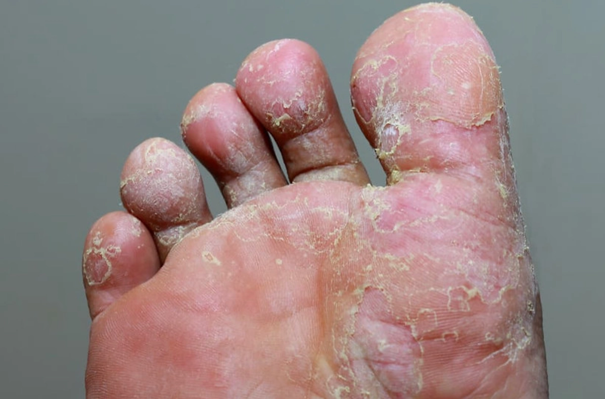 香港腳黴菌幾度會死？專家教你用溫度徹底根治腳氣